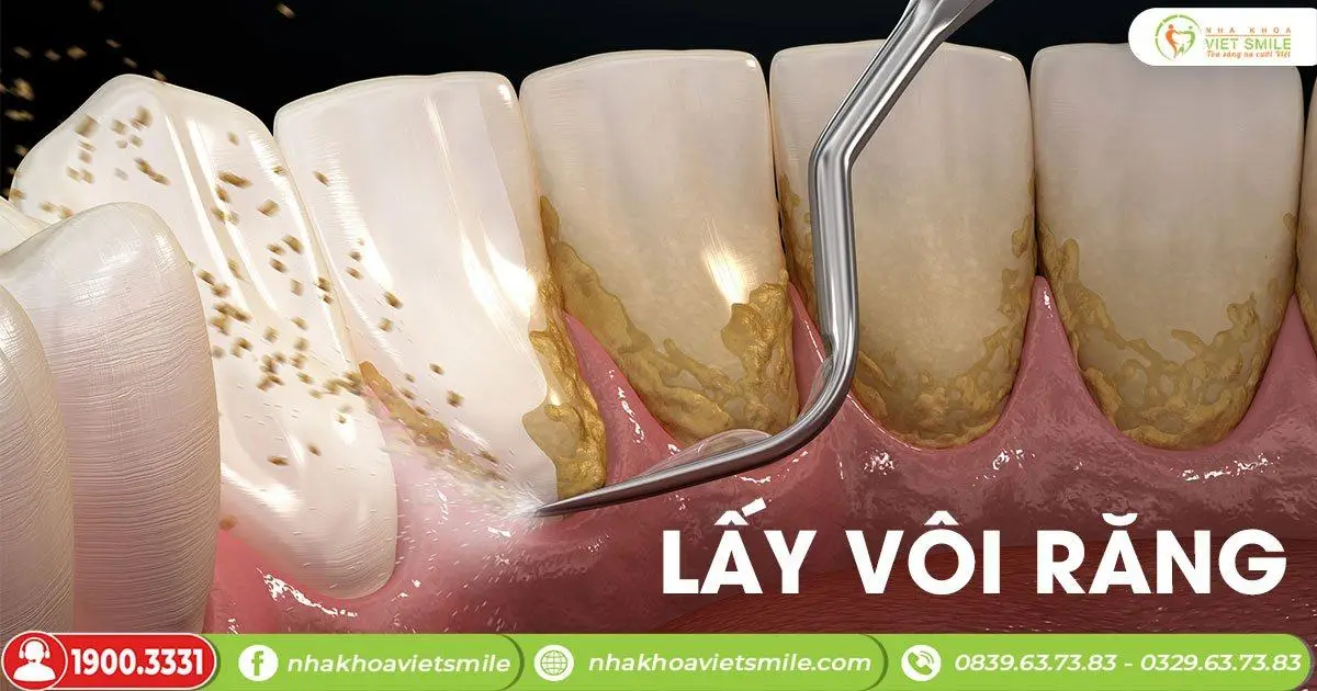 Lấy vôi răng