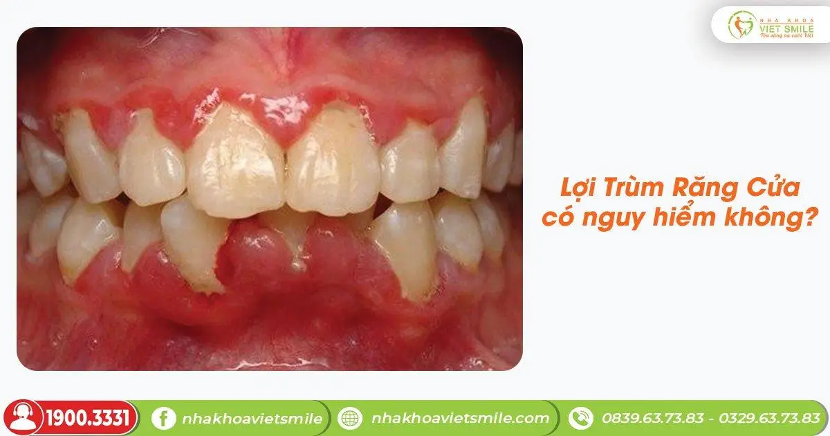 lợi trùm răng cửa
