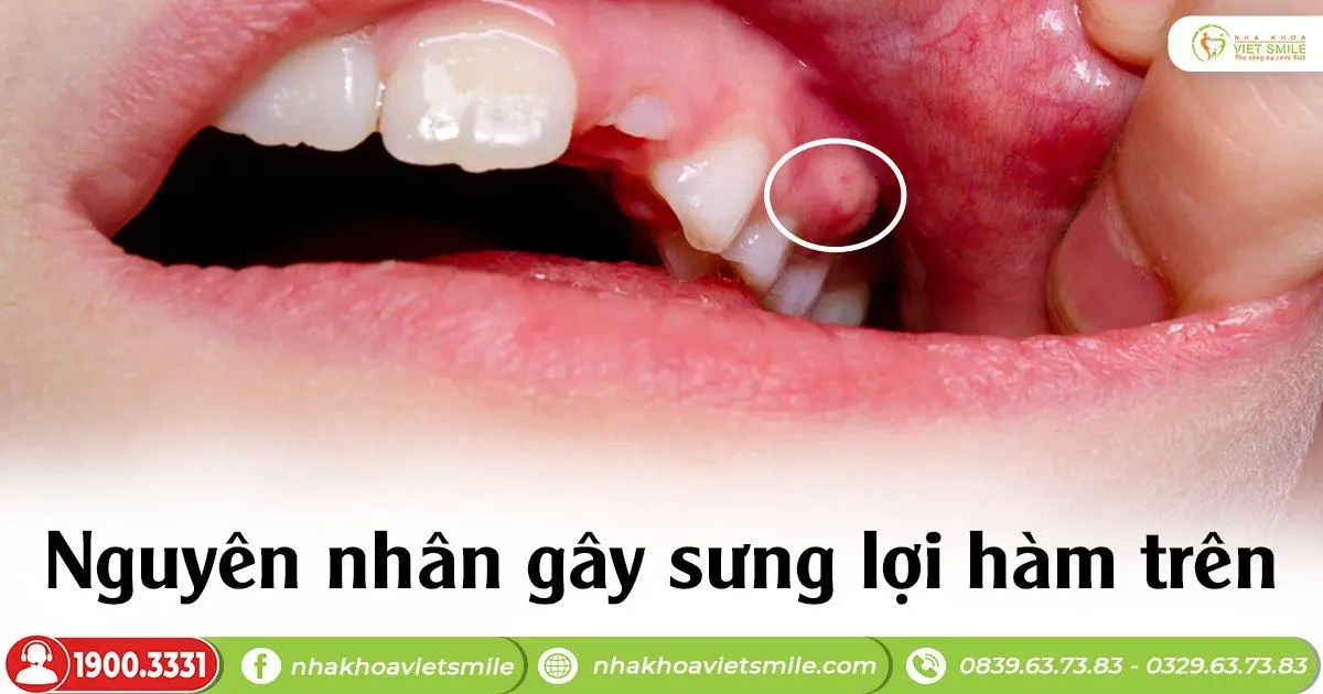Nguyên nhân gây sưng lợi hàm trên