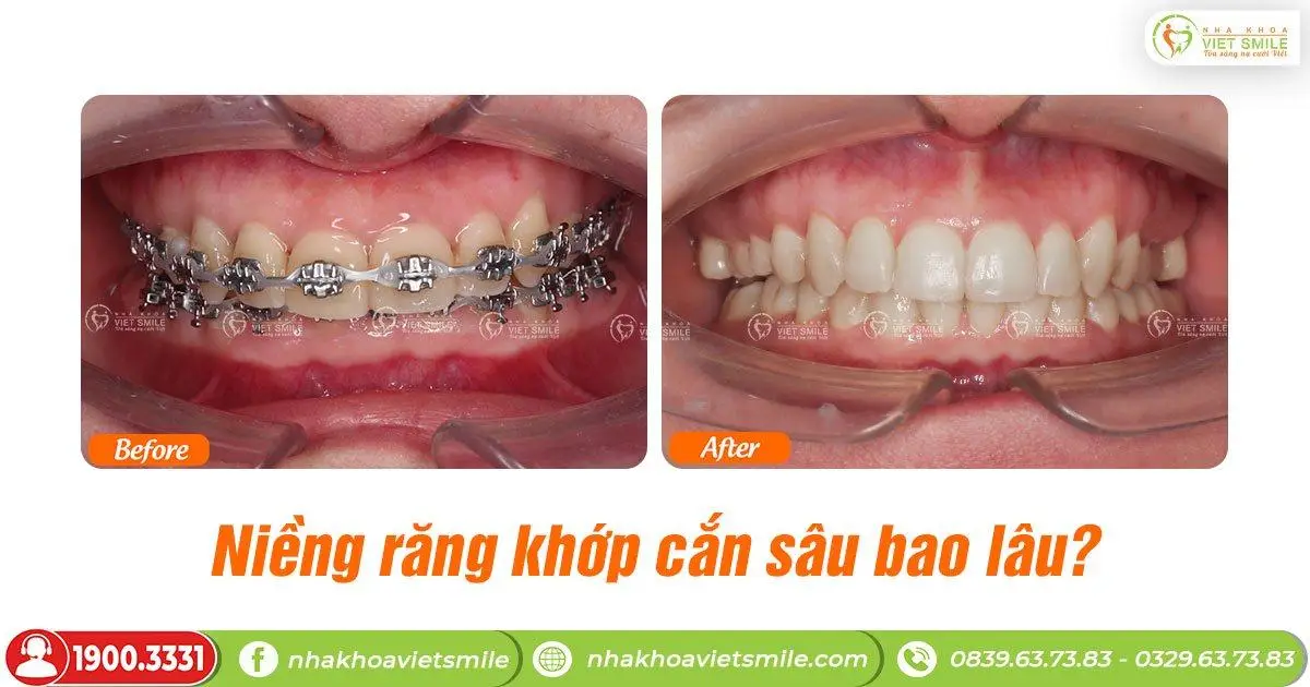 niềng răng khớp cắn sâu