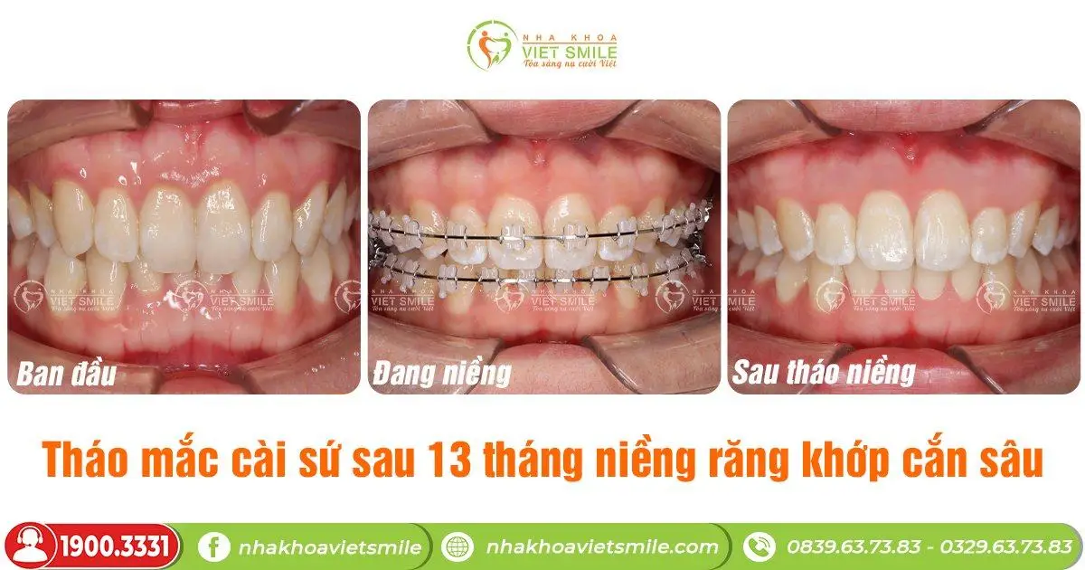 Cải thiện khớp cắn sâu 