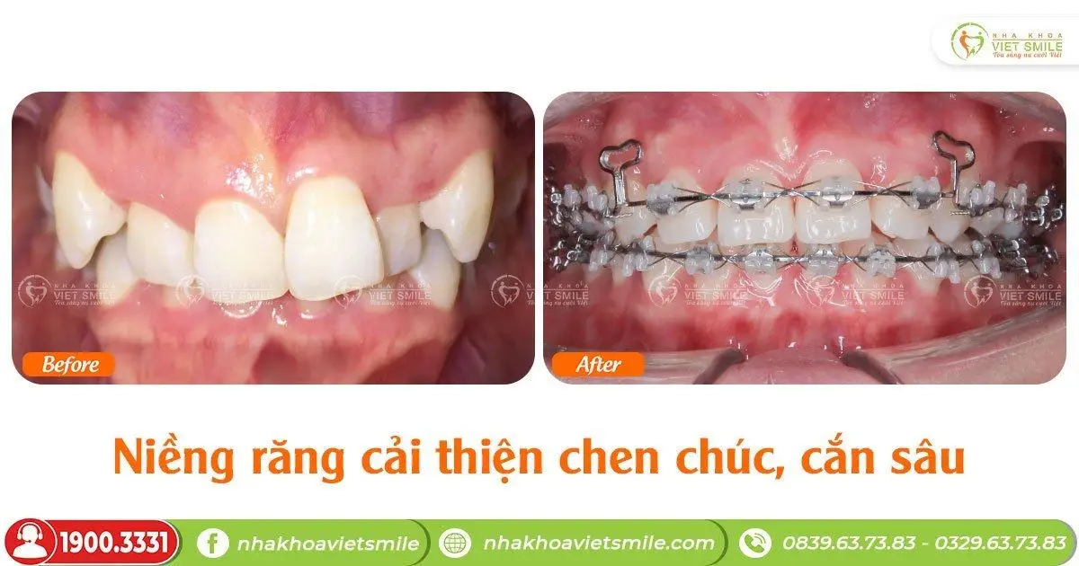 chữa khớp cắn sâu