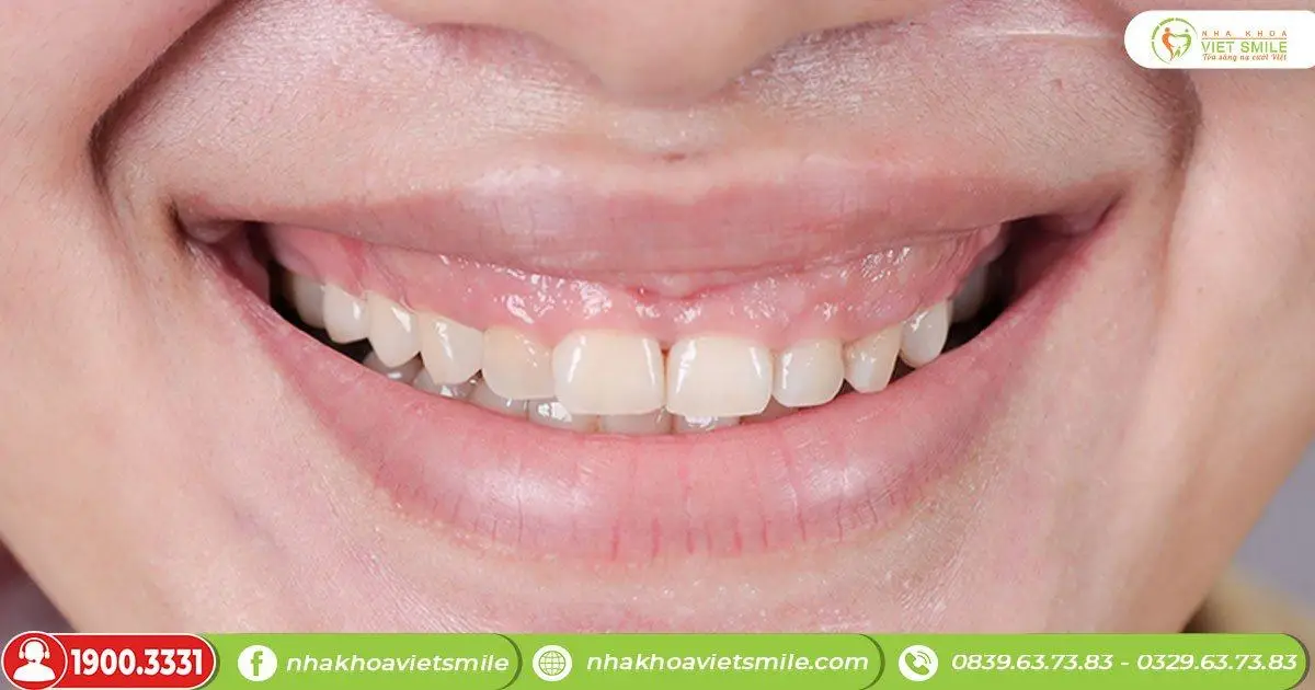  răng ngắn cười hở lợi