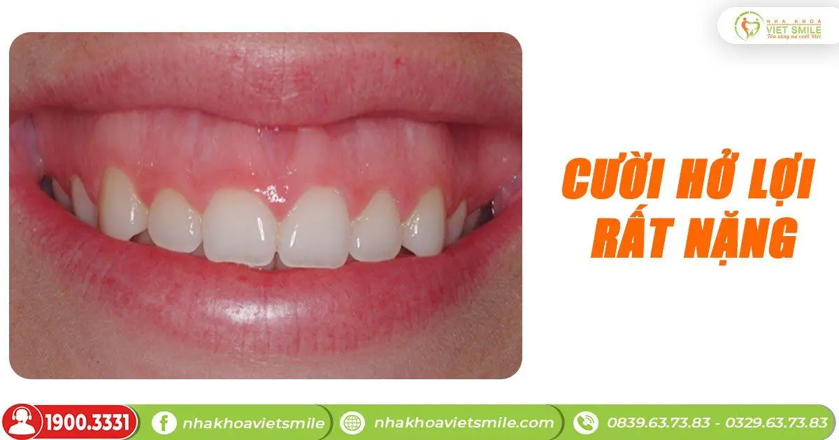 răng ngắn cười hởi lợi