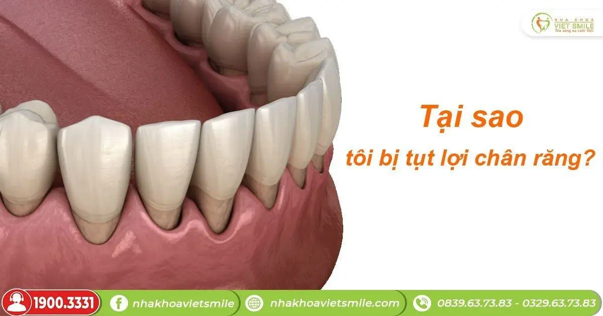 Tại sao tôi bị tụt lợi chân răng?