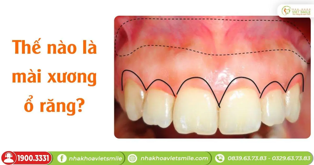 Thế nào là mài xương ổ răng?