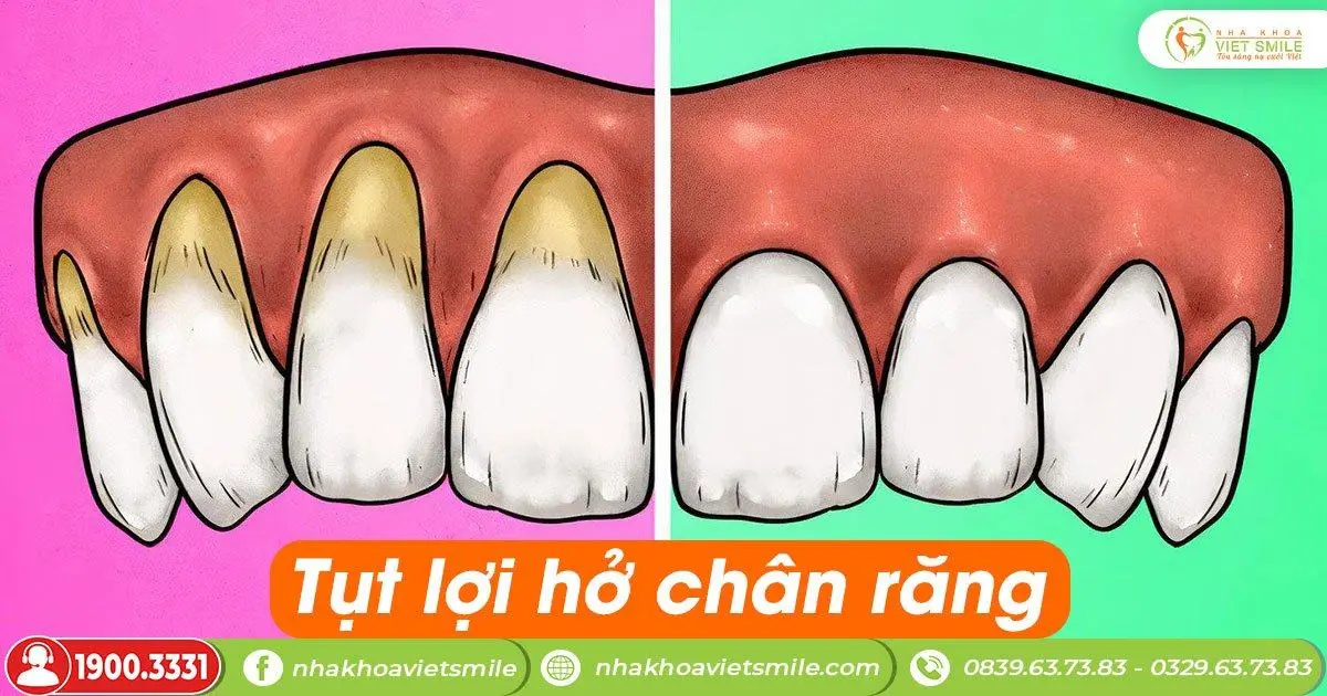 Tụt lợi hở chân răng