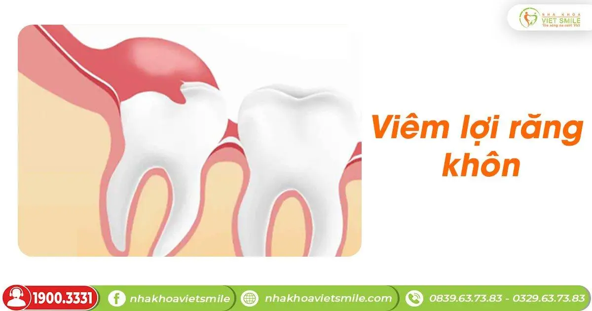 viêm lợi trên răng khôn