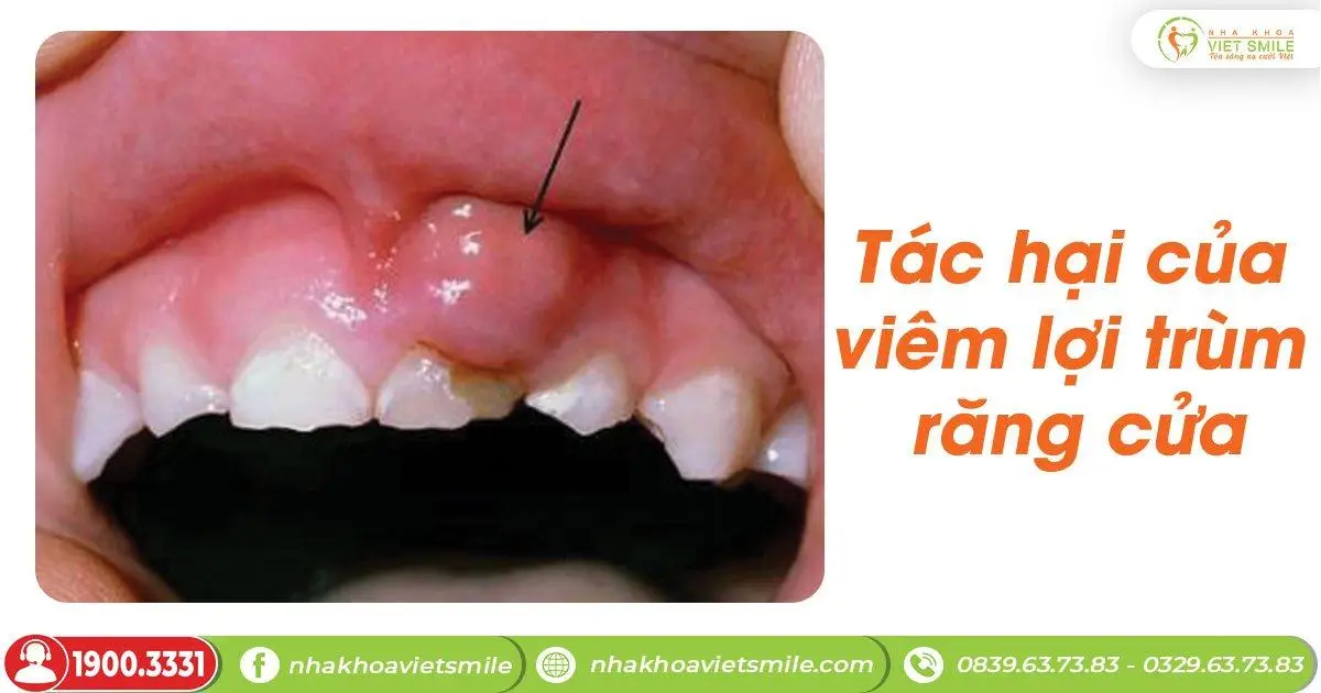 Viêm lợi trùm răng cửa