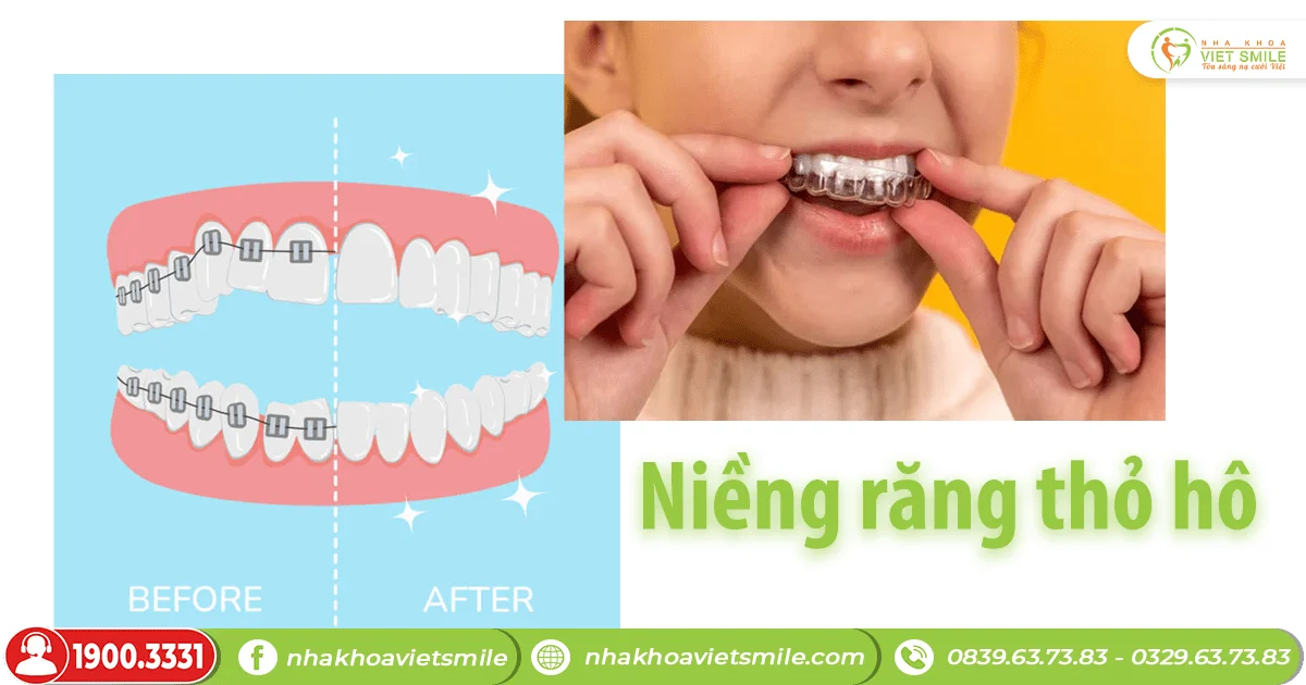 Răng thỏ hô có niềng được không?