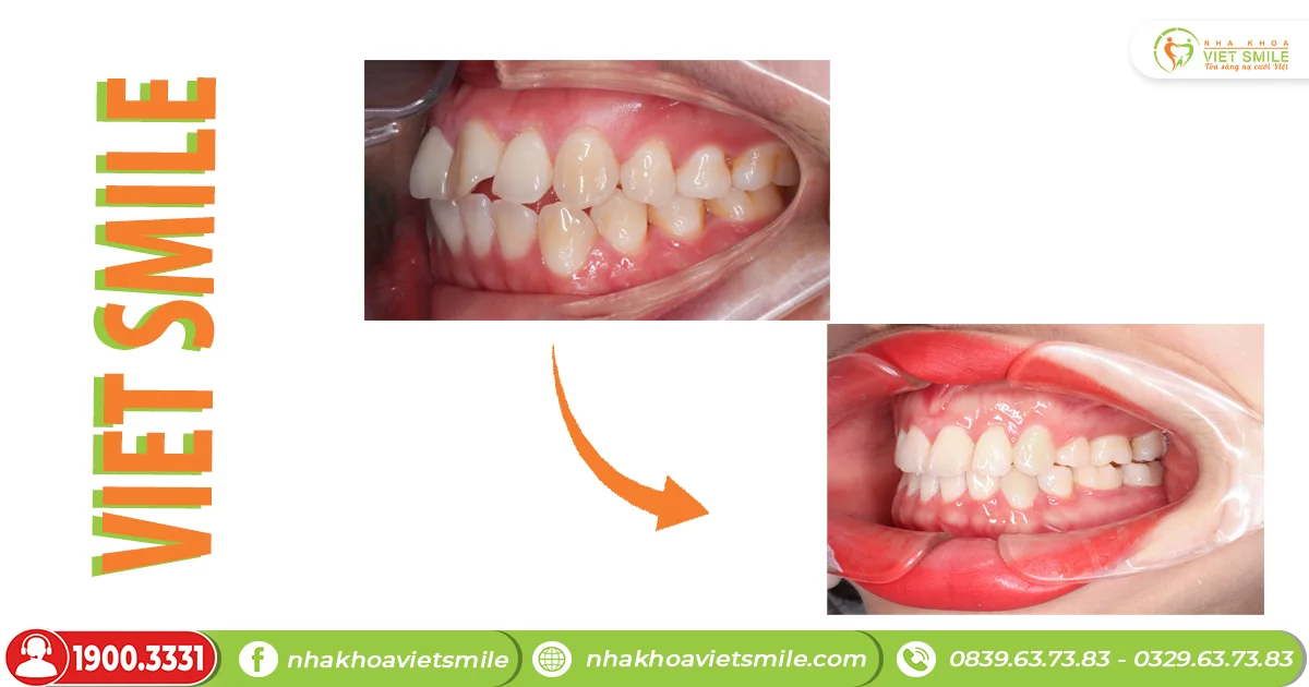 Đồng hành cùng VIET SMILE để có ngay răng thỏ đẹp nào