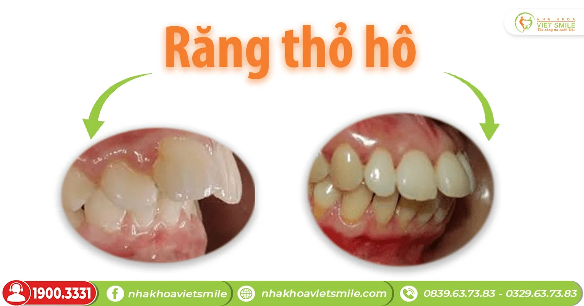 Một số dáng răng thỏ bạn có thể biết