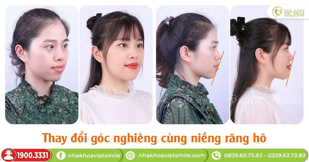 môi dày răng hô