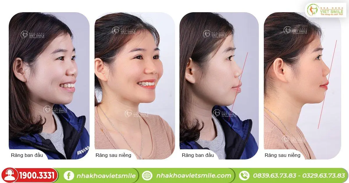 niềng răng đỡ môi dày