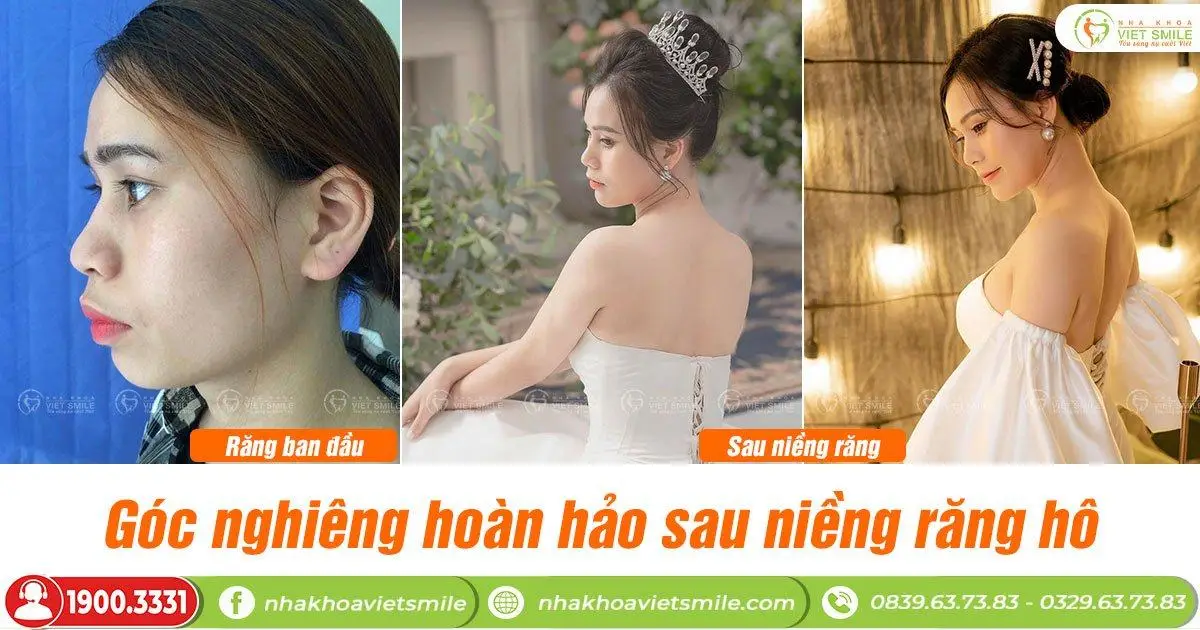 niềng răng chữa môi dày