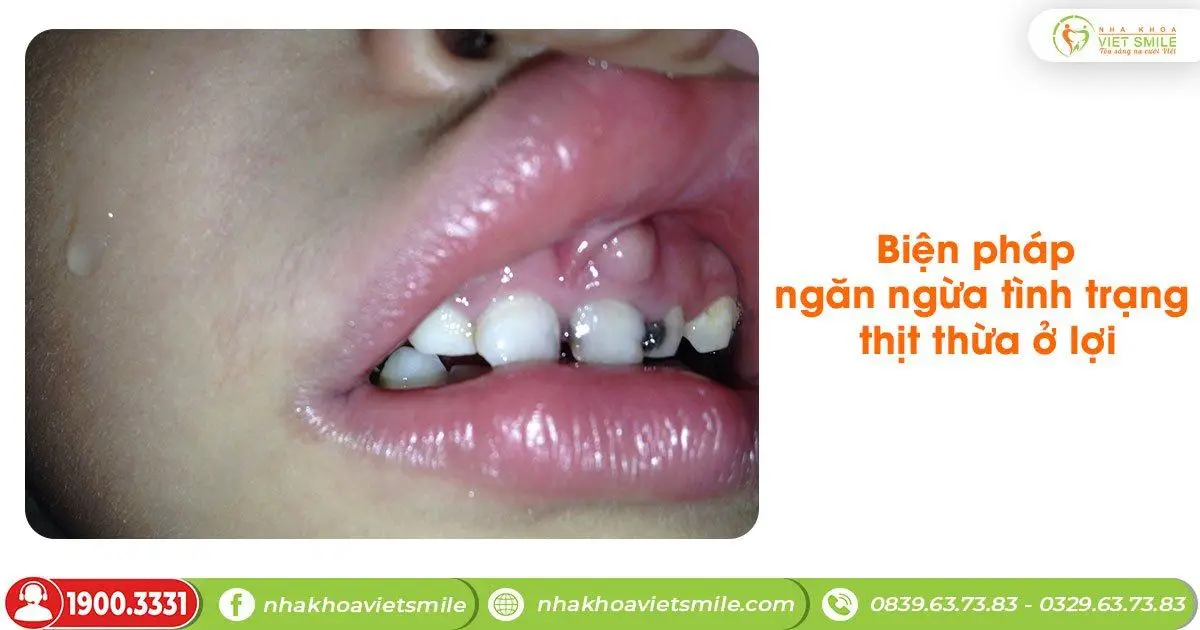 Biện pháp ngăn ngừa mọc thịt thừa ở lợi trẻ em