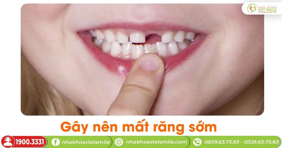 Gây nên mất răng sớm