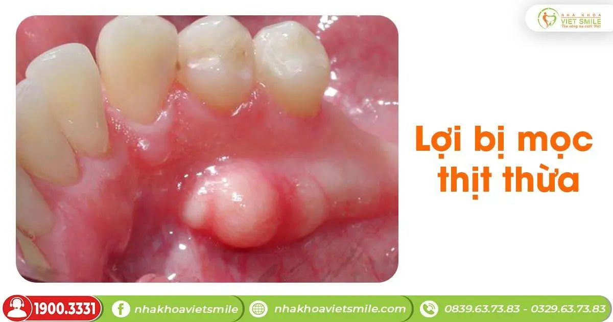 Lợi bị mọc thịt thừa