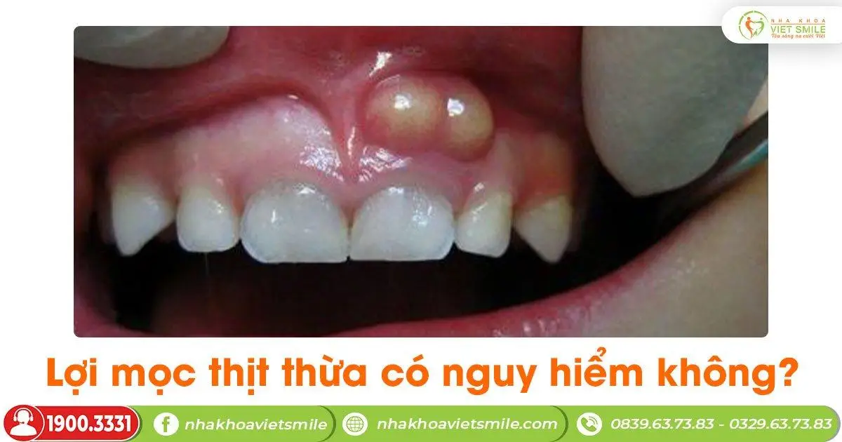 Lợi mọc thịt thừa có nguy hiểm không?