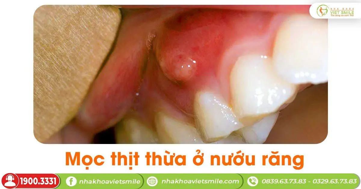 Mọc thịt thừa ở nướu răng