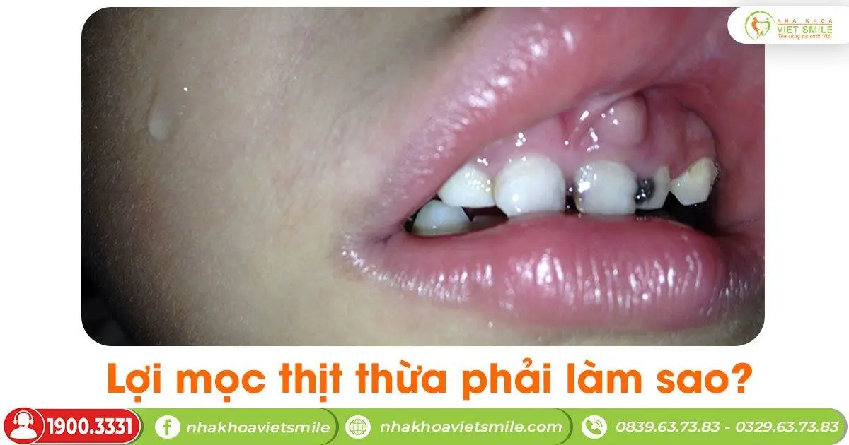 Lợi mọc thịt thừa có nguy hiểm không?