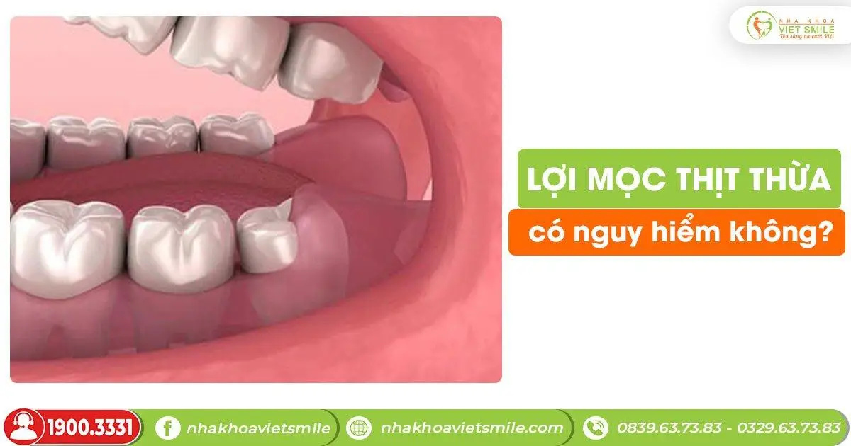 Lợi mọc thịt thừa có nguy hiểm không?