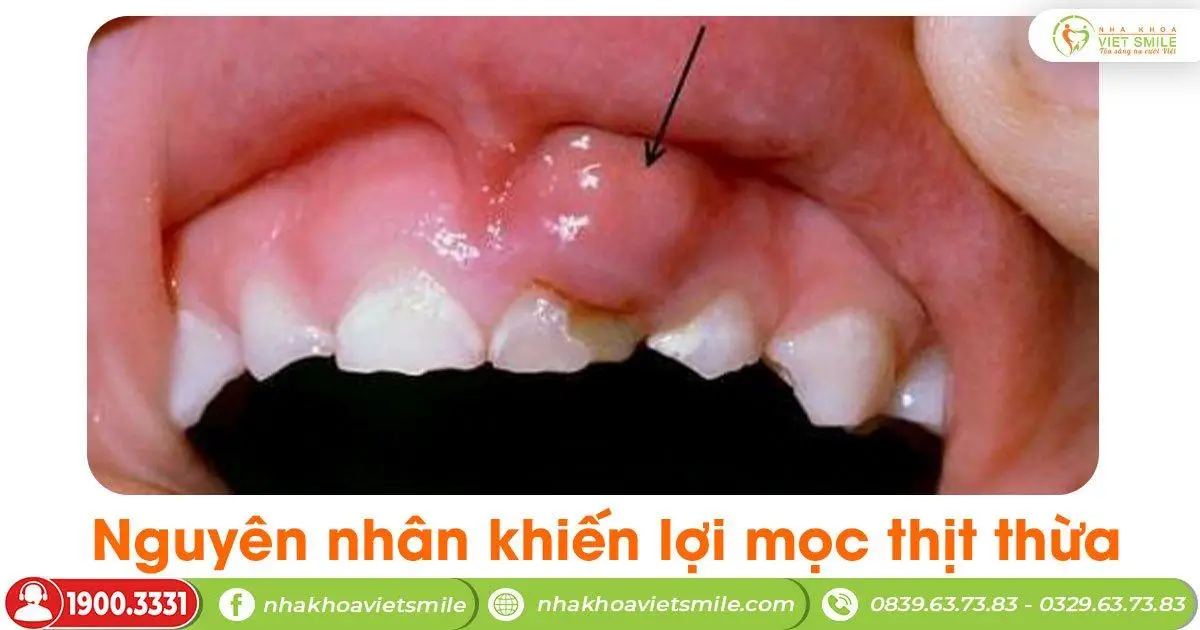 Nguyên nhân khiến lợi mọc thịt thừa