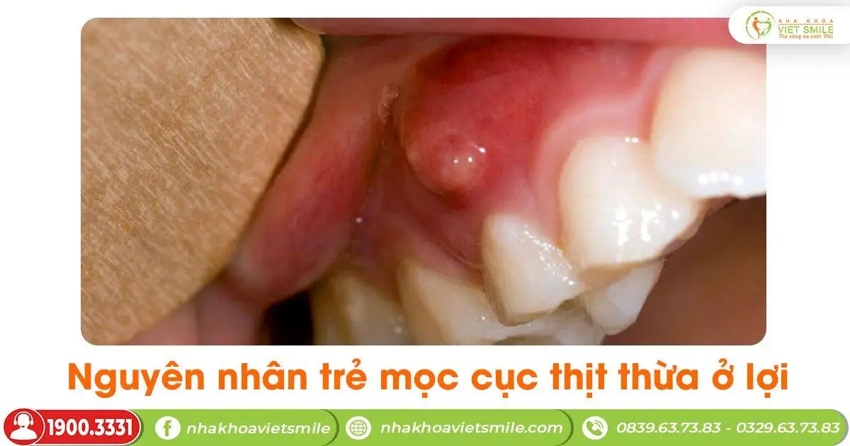 Nguyên nhân trẻ mọc cục thịt thừa ở lợi