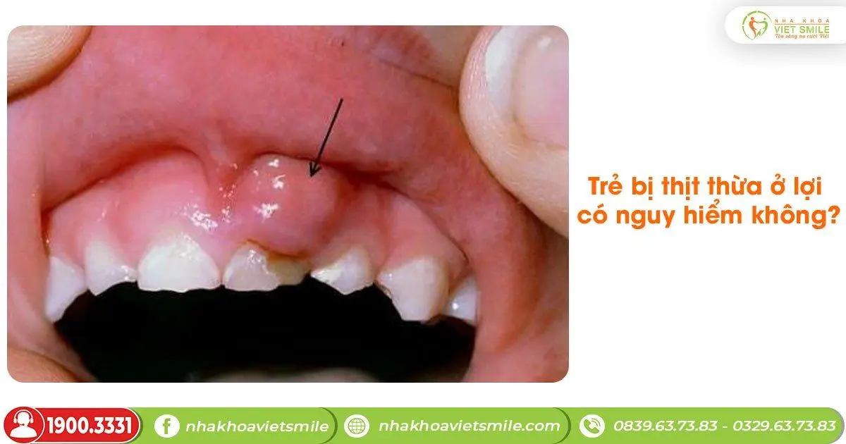 Trẻ bị thịt thừa ở lợi có nguy hiểm không?