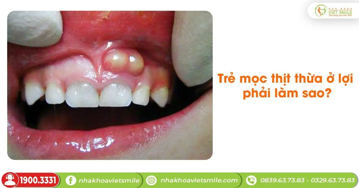 Trẻ bị mọc thịt thừa ở lợi phải làm sao?