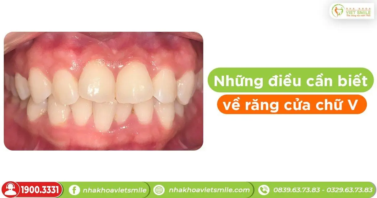 Những điều cần biết về răng cửa chữ V!