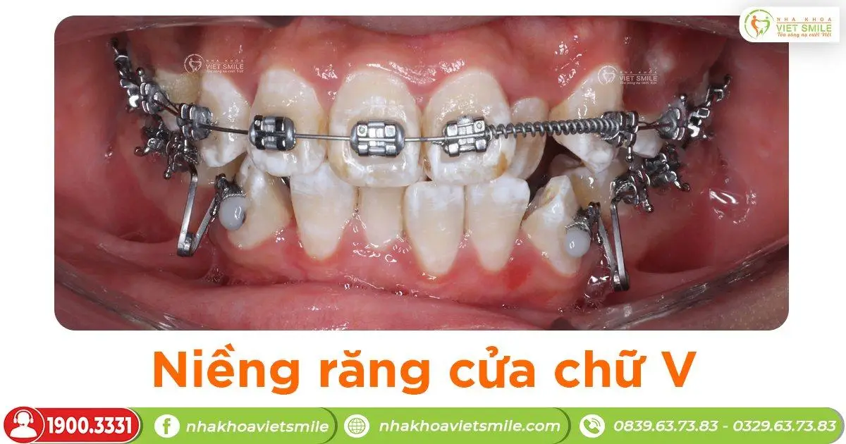 Niềng răng cửa chữ V