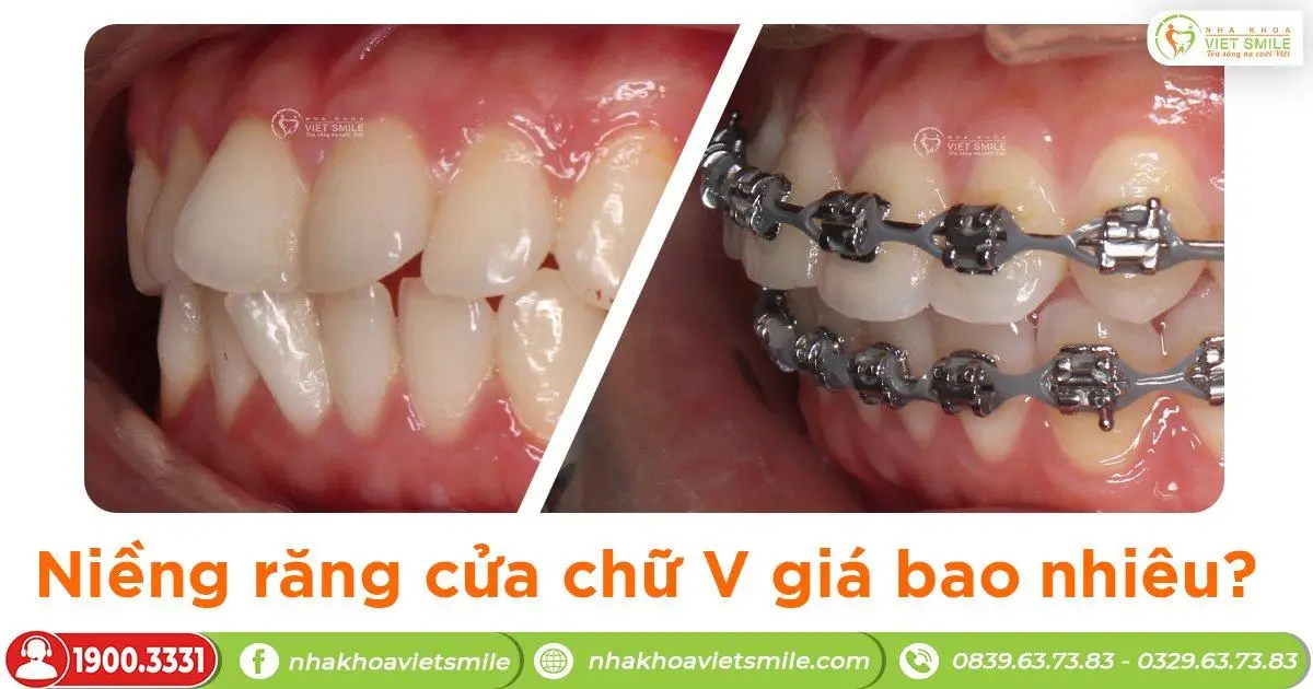Niềng răng cửa chữ V giá bao nhiêu?