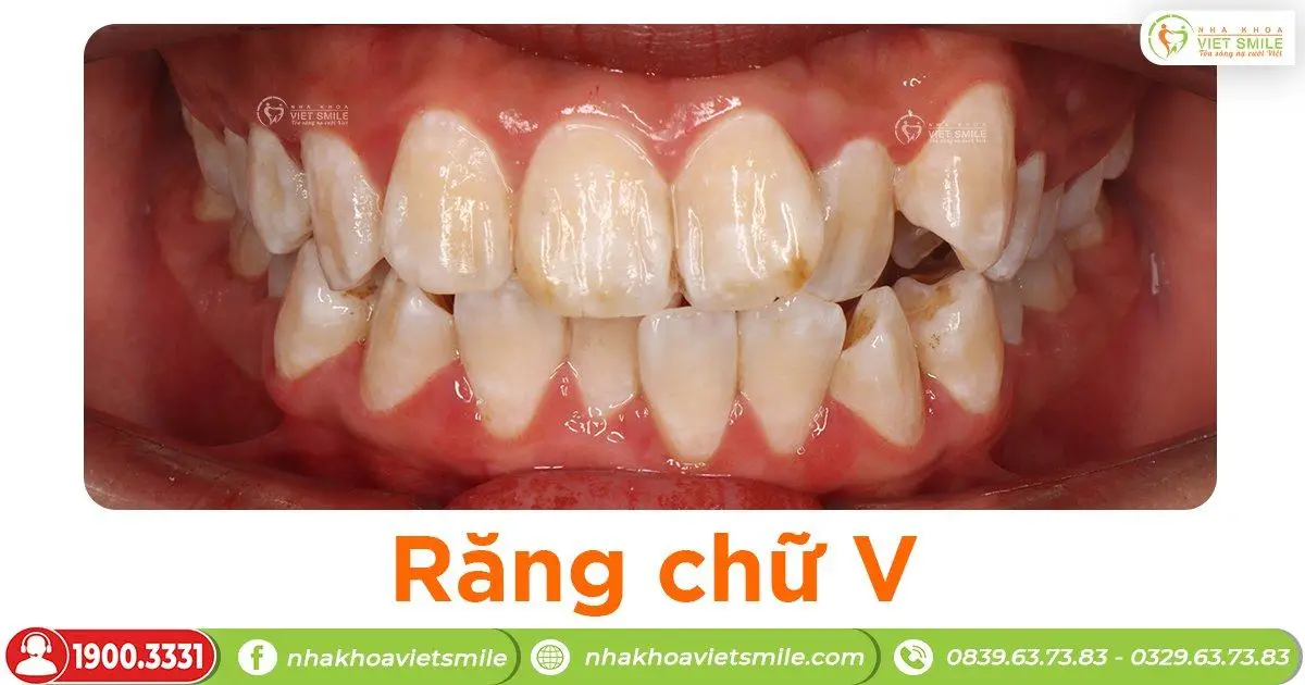Răng chữ V