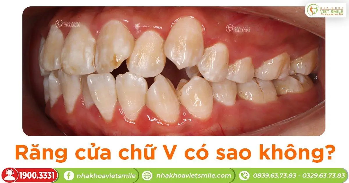 Răng cửa chữ V có sao không?