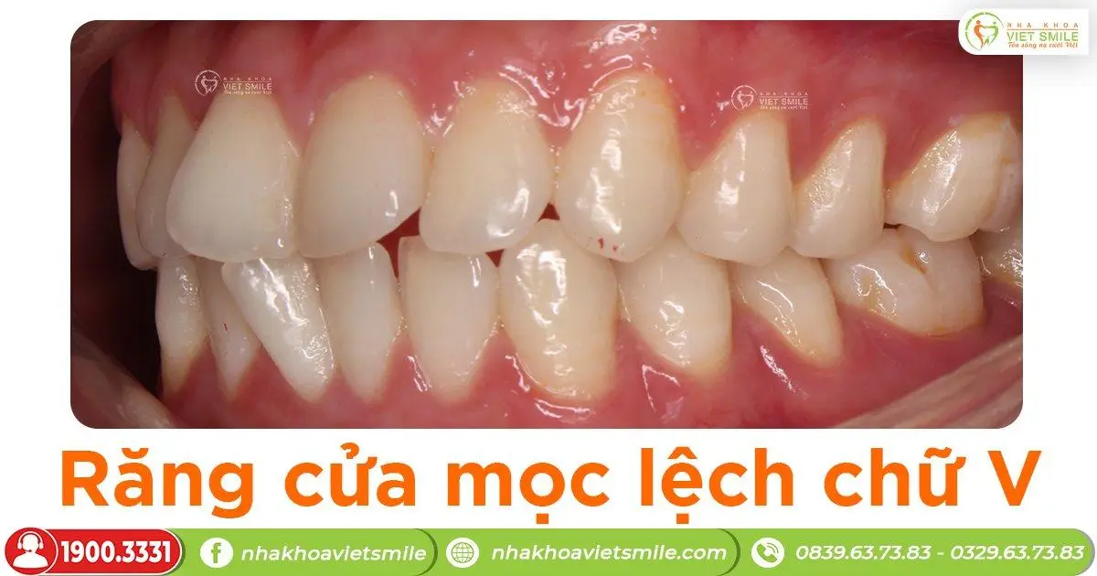Răng cửa mọc lệch hình chữ V