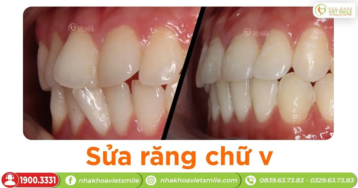 Sửa răng cửa chữ V