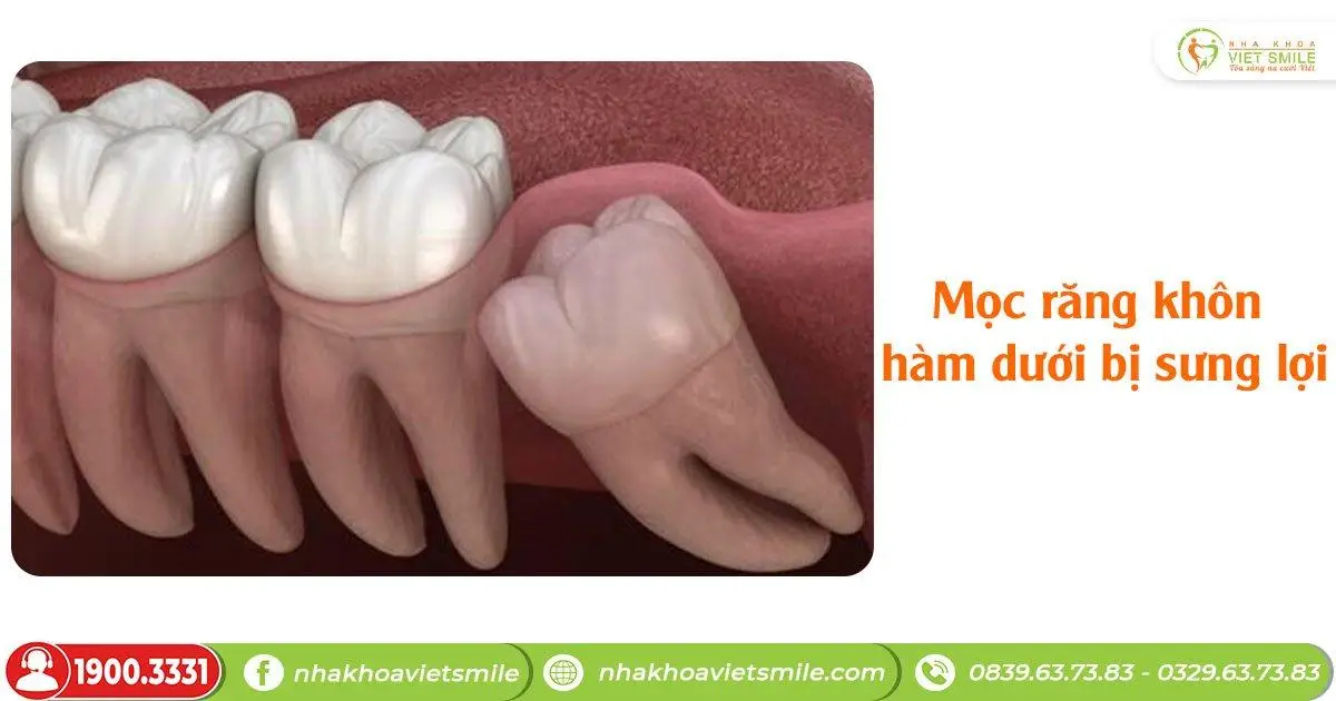 Mọc răng khôn hàm dưới bị sưng lợi