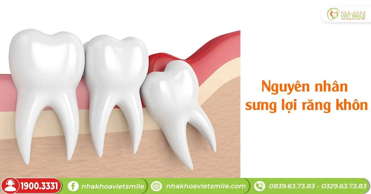 Nguyên nhân sưng lợi răng khôn