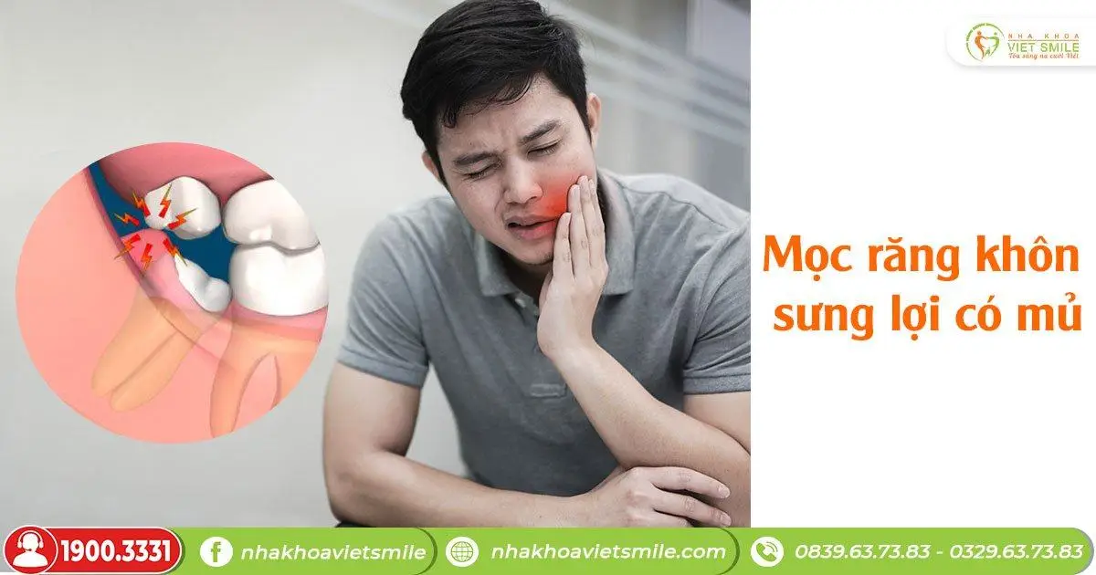 Mọc răng khôn có bị sưng lợi không?