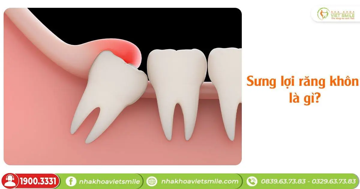 Sưng lợi răng khôn là gì?