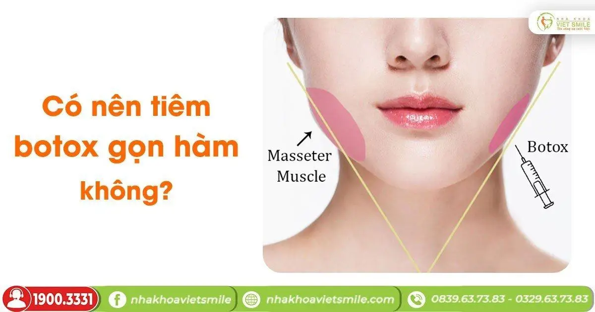 Tiêm botox gọn hàm