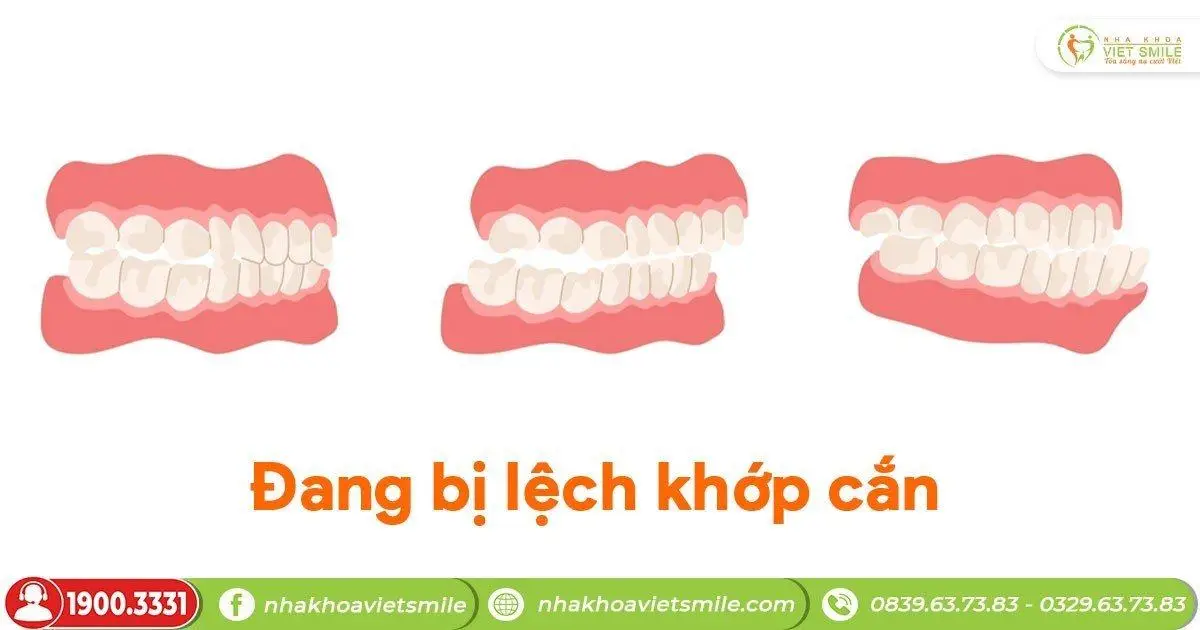 Đang bị lệch khớp cắn