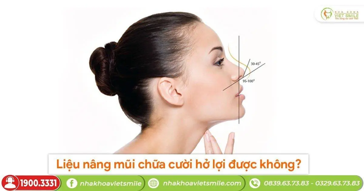 Liệu nâng mũi chữa cười hở lợi được không?