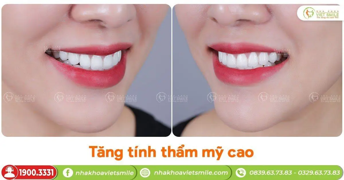 Tăng tính thẩm mỹ cao