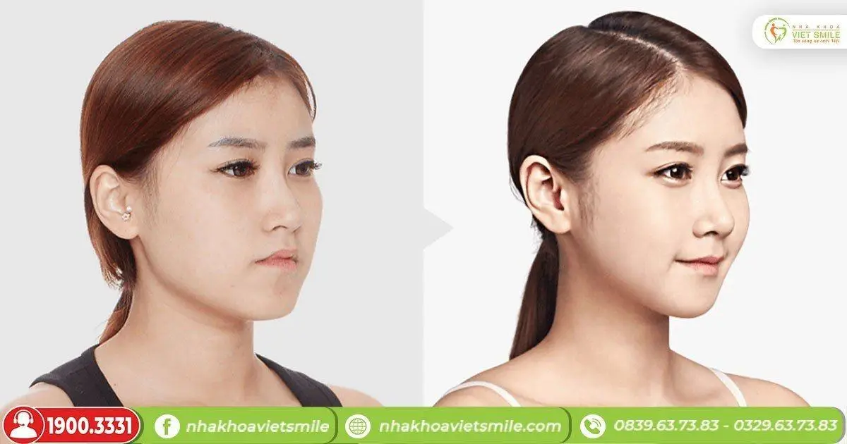 Tiêm botox gọn hàm