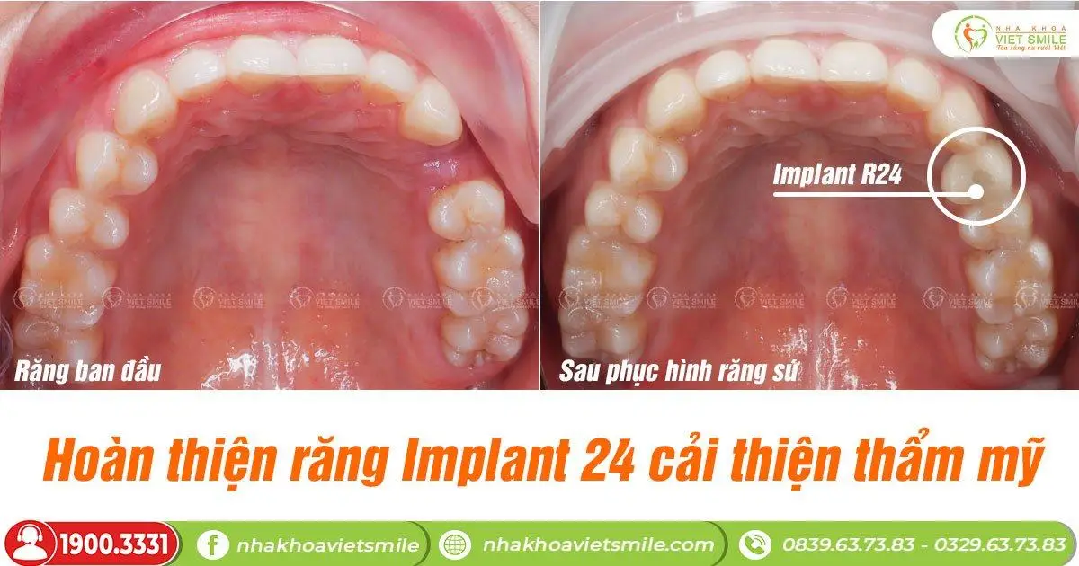 Trồng răng implant cải thiện thẩm mỹ, ăn nhai
