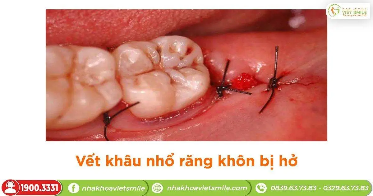Vết khâu sau nhổ răng bị hở