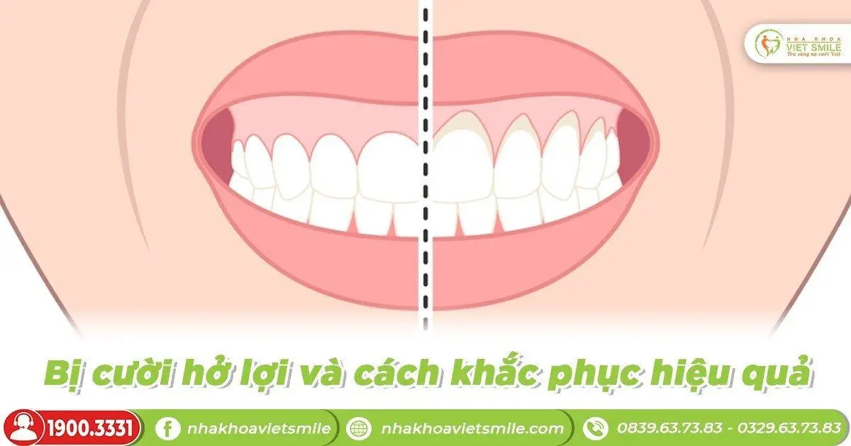 Bị cười hở lợi và cách khắc phục hiệu quả