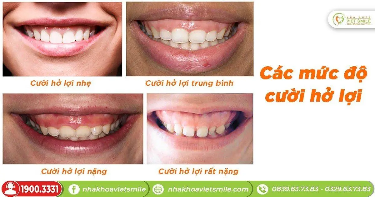 Các mức độ cười hở lợi là gì?
